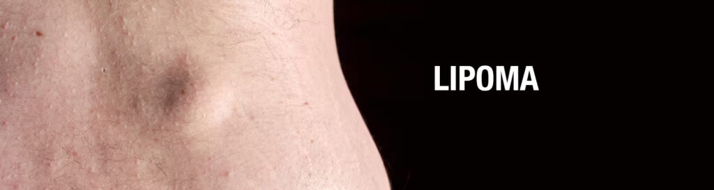 lipoma