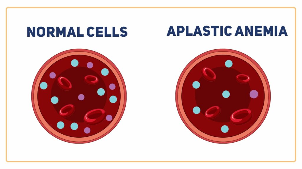 Aplastic-anemia-stage-1-