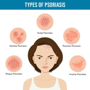 Types of Psoriasis