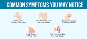 What are the common signs and symptoms of Psoriasis